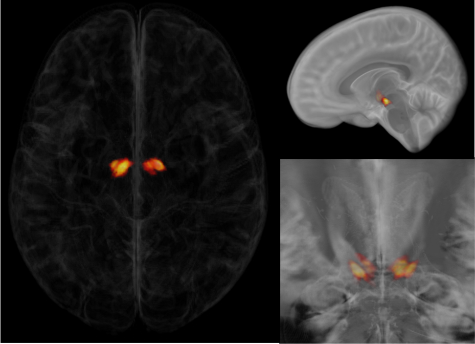 Atlas of the Sub-thalamic Nucleus