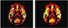 CBF maps before and after applying PVC-mLTS