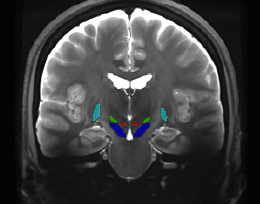 Deep brain T2w 7T atlas