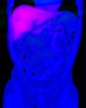  ELV soft-segmentation of the liver