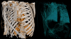 CT scan with color scheme set to Kidneys and Airways