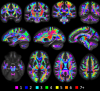 Bottleneck regions in the human brain