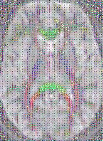 Orientation distribution functions for an in vivo STE image.