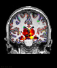 Connectivity in subcortical volume