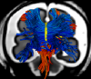 tractography coronal