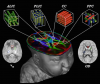 NeuroImage Cover Image for NODDI in Neonates