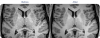 ORNLM Filter