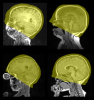 Typical results of FOV normalization.
